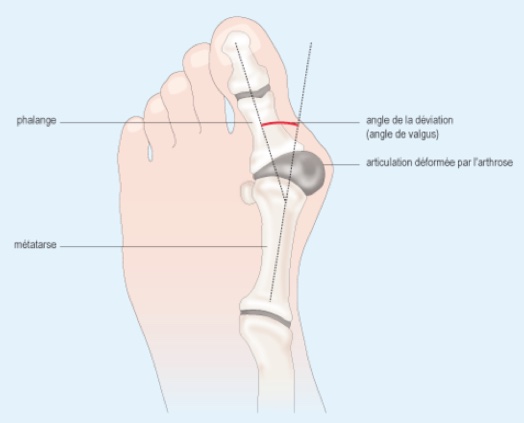 hallux valgus est une déformation de l'avant-pied d'origine héréditaire